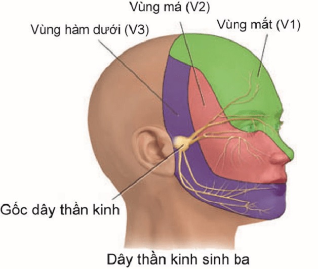 Bệnh lý điển hình của 12 dây thần kinh sọ não