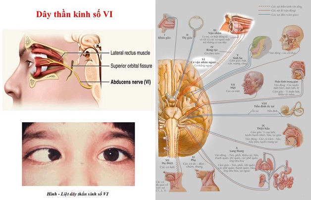 Bệnh lý điển hình của 12 dây thần kinh sọ não