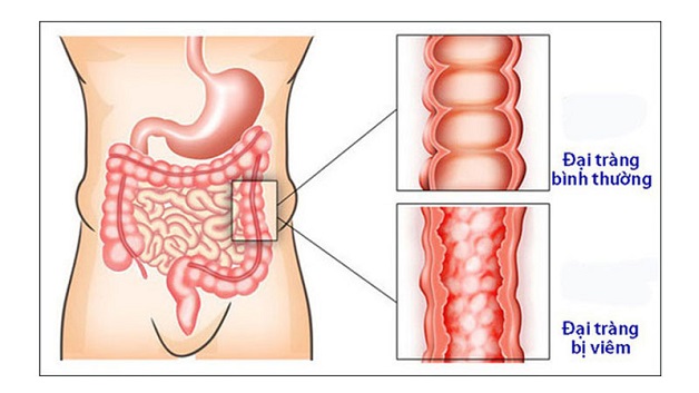 Bệnh lý đường tiêu hóa thường gặp và cách phòng tránh