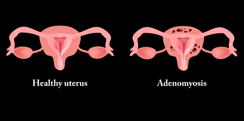 Bệnh lý lạc nội mạc tử cung là gì?