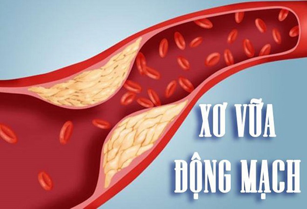 Bệnh lý mạch vành: Cách phân loại và điều trị