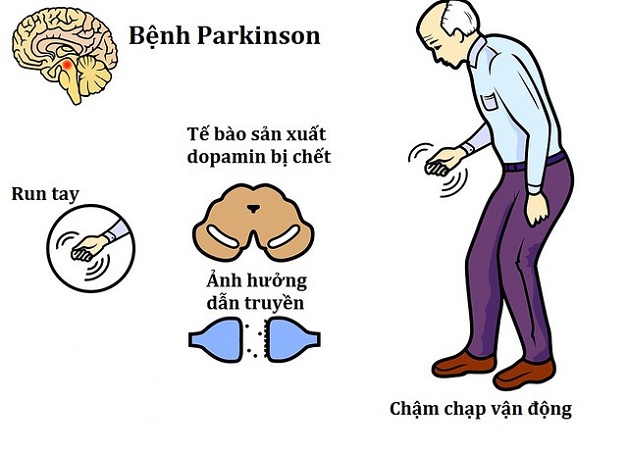 Bệnh lý Parkinson không đáng sợ như nhiều người nghĩ