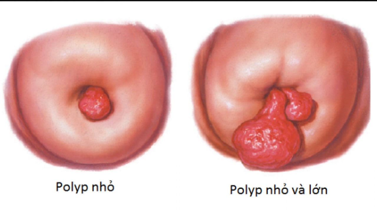 Bệnh lý Polyp cổ tử cung có nguy hiểm không?