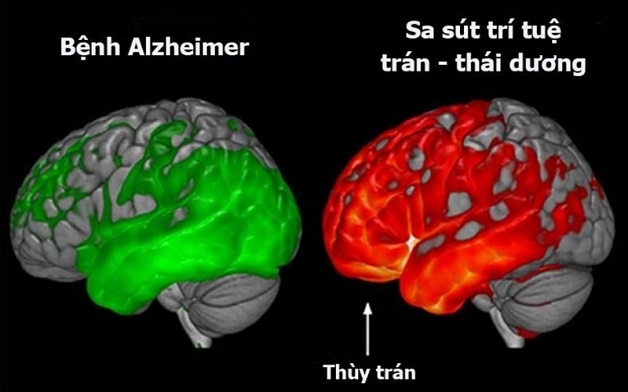 Bệnh lý sa sút trí tuệ tâm thần cần thăm khám sớm