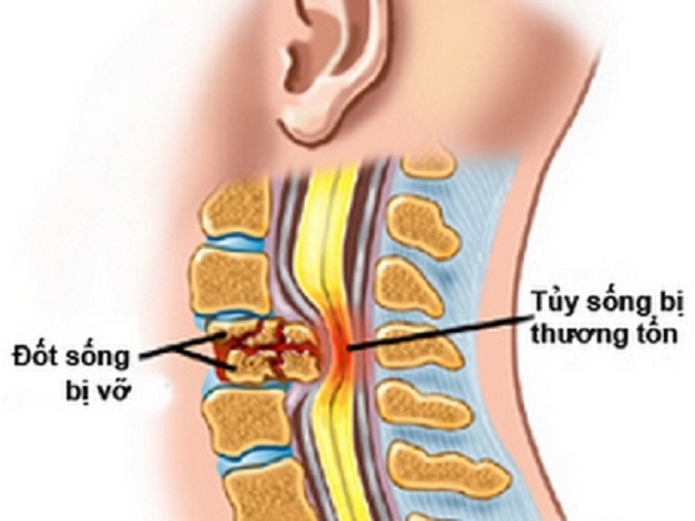 Bệnh lý tủy sống thường gặp: chẩn đoán và điều trị