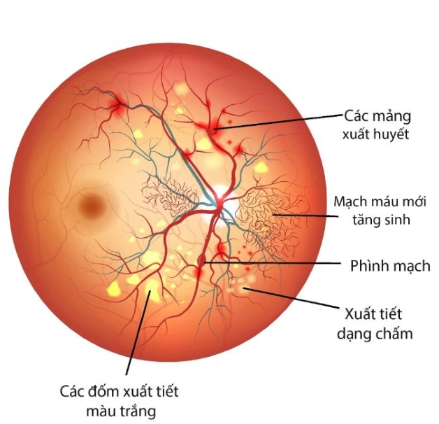 Bệnh lý viêm kết mạc xuất huyết có nguy hiểm không?