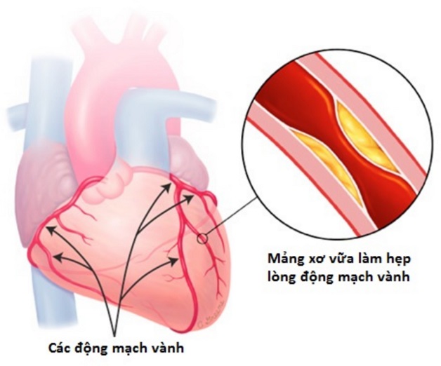 Bệnh mạch vành 3 nhánh là gì? Cách chẩn đoán, điều trị