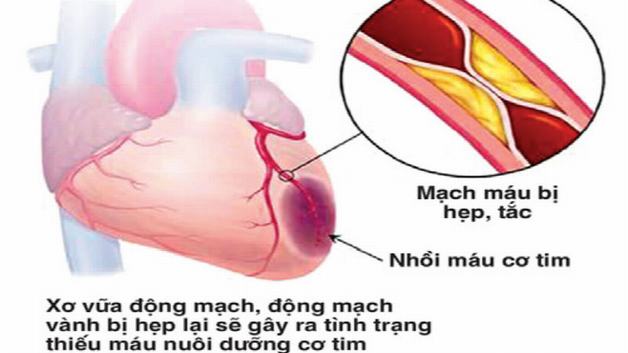 Bệnh mạch vành cấp: Triệu chứng, chẩn đoán và điều trị