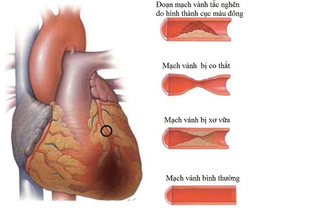 Bệnh mạch vành có nguy hiểm không, làm sao để phòng tránh?