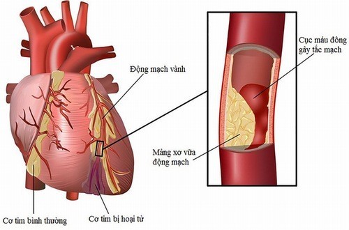 Bệnh mạch vành ở người cao tuổi thường khó phát hiện