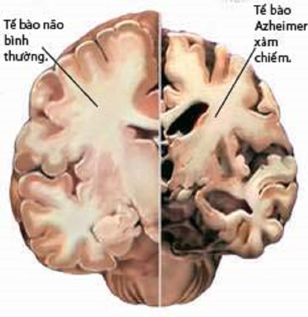 Bệnh mất trí nhớ Alzheimer nguy hiểm cỡ nào?