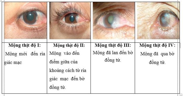 Bệnh mộng mắt: Biểu hiện, nguyên nhân và cách điều trị