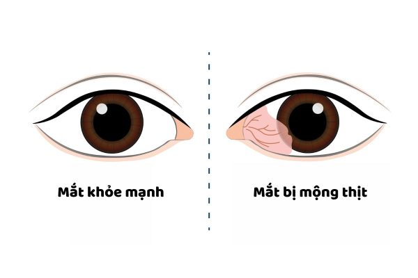 Bệnh mộng thịt ở mắt: Nguyên nhân, dấu hiệu, cách điều trị