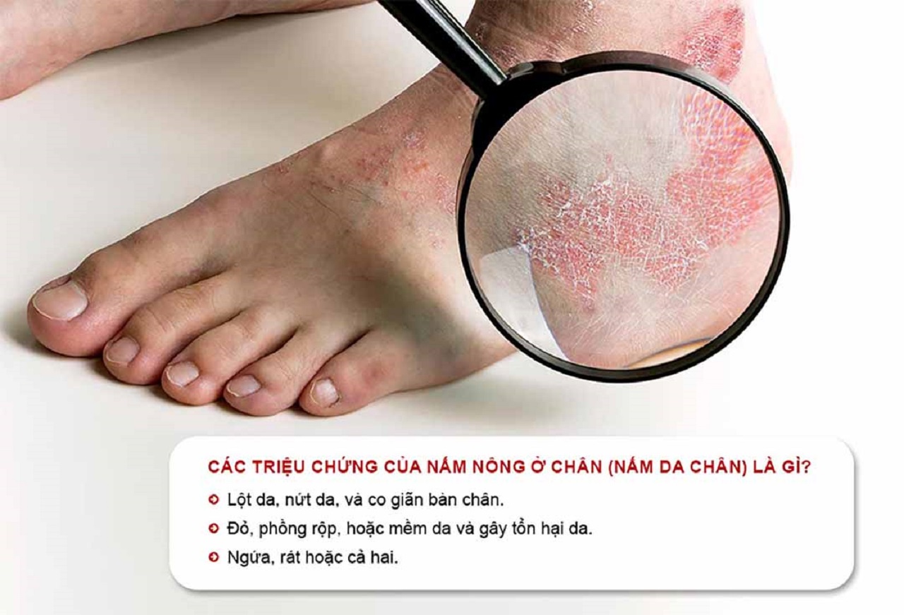 Bệnh nấm da bàn chân cần lưu ý điều gì khi điều trị