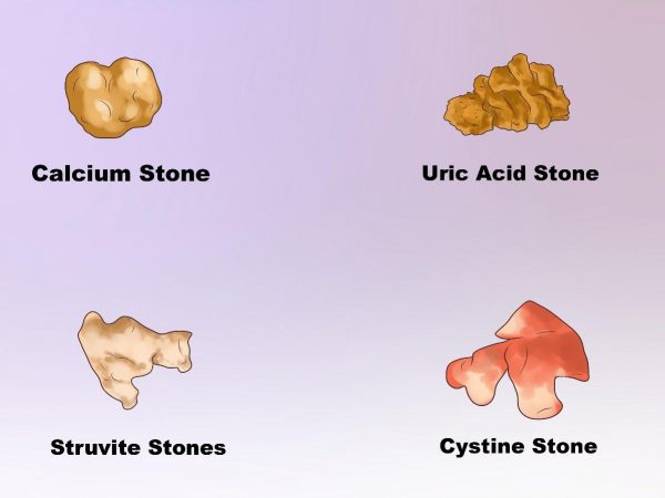 Bệnh nhân mắc bệnh gout có thể bị sỏi thận acid uric