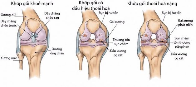 Bệnh nhân thoái hóa khớp gối có nên tập yoga hay không?