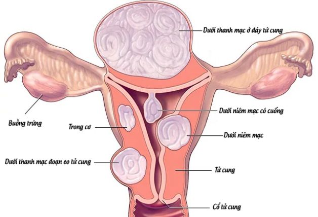 Bệnh nhân xơ cổ tử cung: Triệu chứng và cách điều trị