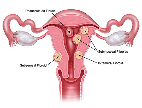 Bệnh nhân xơ tử cung là gì? Cách nhận biết và xử trí kịp thời