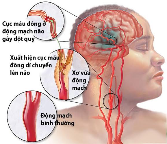 Bệnh nhồi máu não và cách điều trị