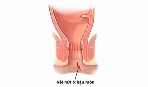 Bệnh nứt kẽ hậu môn có nguy hiểm không?