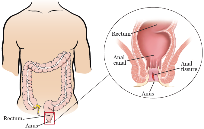 Bệnh nứt kẽ hậu môn và những điều bạn cần biết