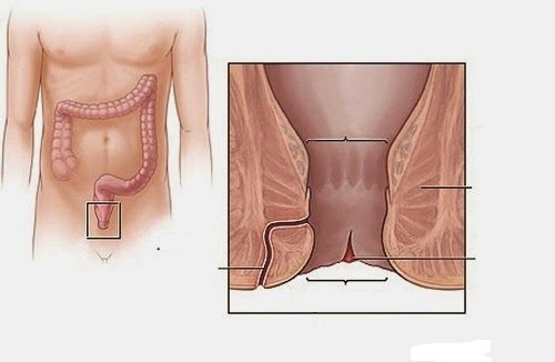 Bệnh nứt kẽ hậu môn