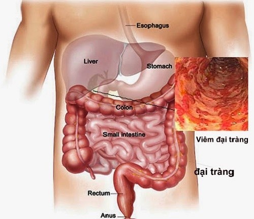 Bệnh ở đại tràng – lành tính và ác tính