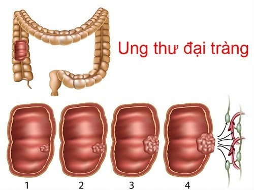 Bệnh ở đại tràng – lành tính và ác tính