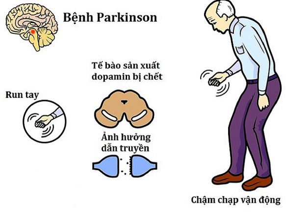 Bệnh parkinson là gì? Từ nguyên nhân đến điều trị