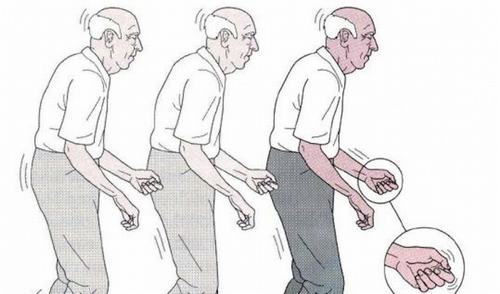 Bệnh Parkinson và nguyên nhân gây bệnh