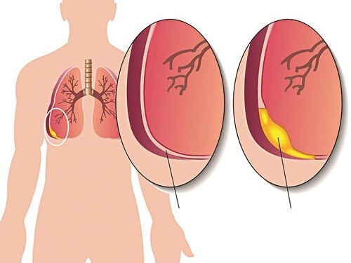 Bệnh phổi có nước là gì?nguyên nhân gây bệnh