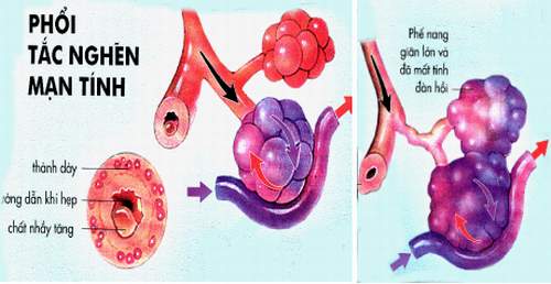 Bệnh phổi tắc nghẽn mạn tính: Coi chừng biến chứng nguy hiểm