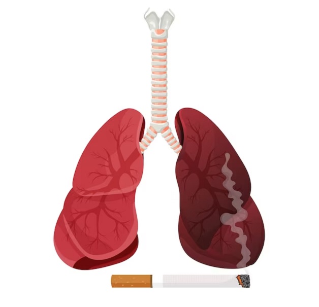 Bệnh phổi tắc nghẽn mạn tính COPD: Cách quản lý và điều trị