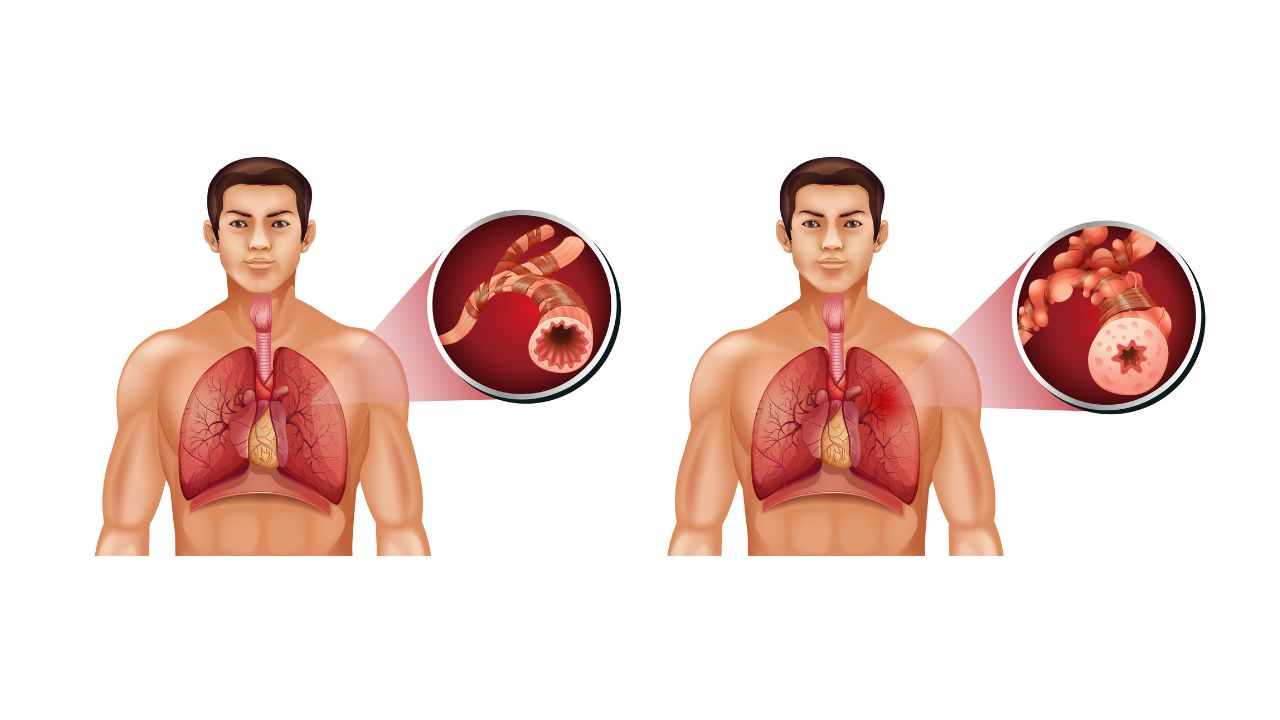 Bệnh phổi tắc nghẽn mạn tính (COPD): Triệu chứng và cách điều trị