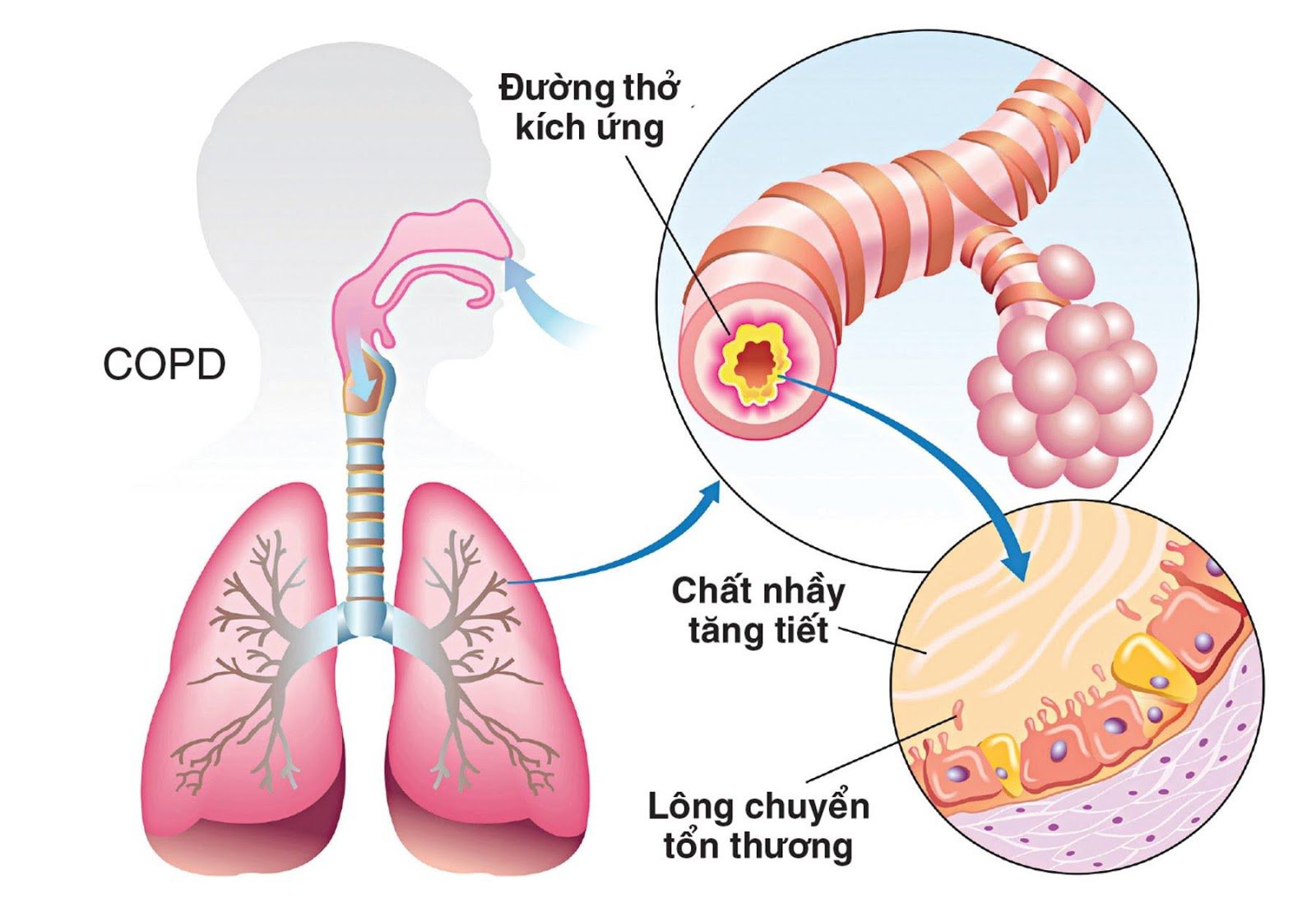 Bệnh phổi tắc nghẽn mạn tính là gì