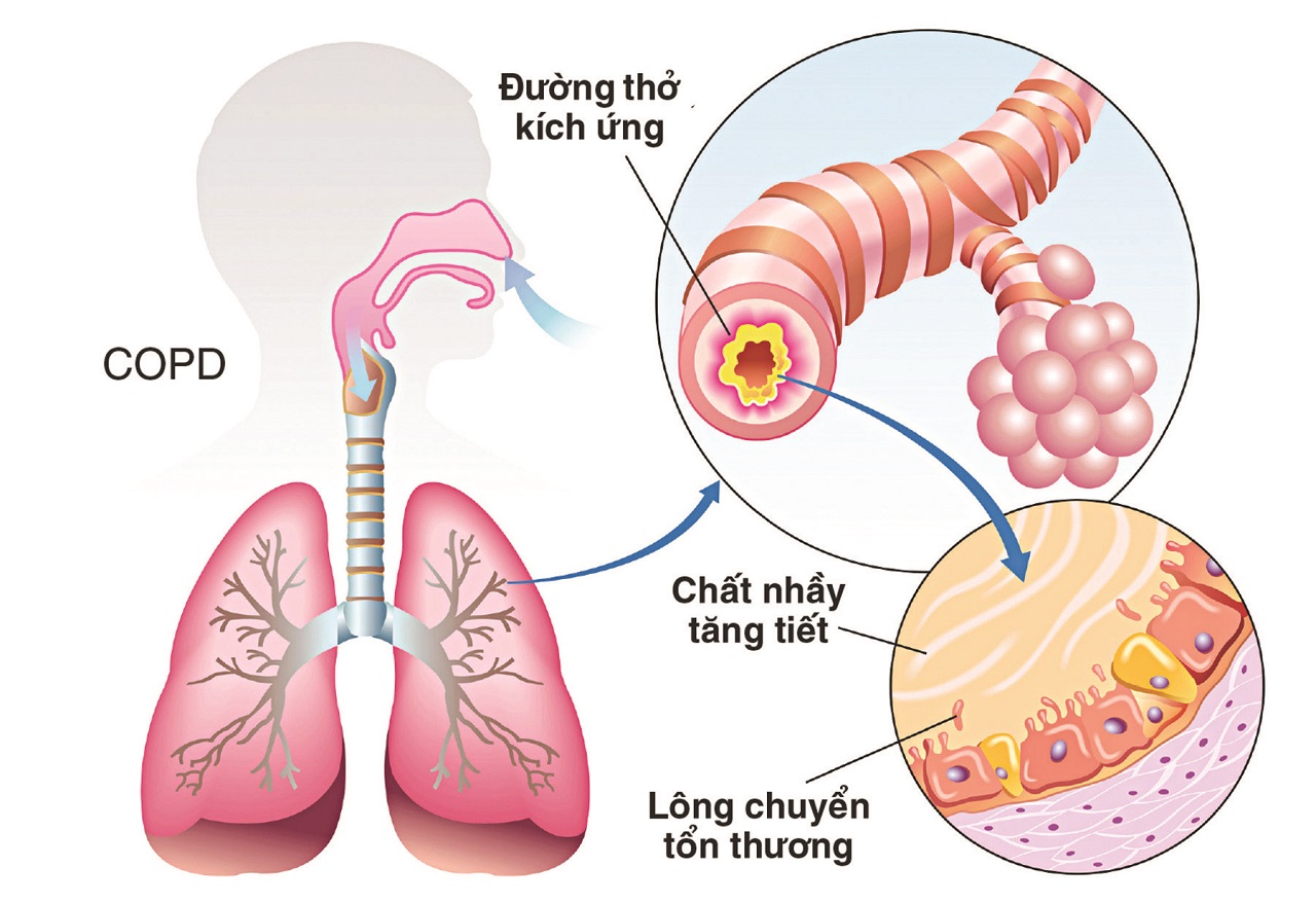 Bệnh phổi tắc nghẽn mạn tính ở người già cần lưu ý điều gì