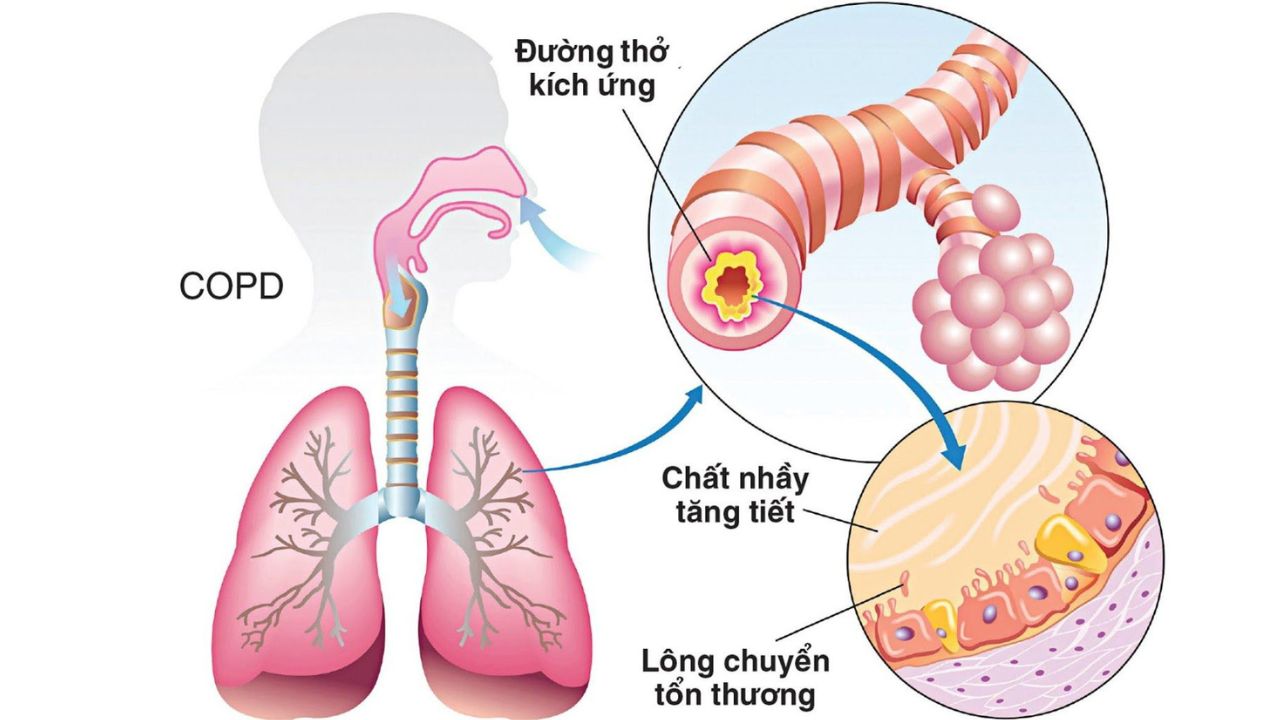 Bệnh phổi tắc nghẽn mãn tính, triệu chứng, cách điều trị