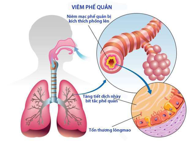 Bệnh phổi tắc nghẽn mãn tính, triệu chứng, cách điều trị