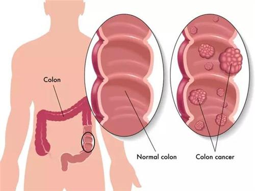 Bệnh polyp dạ dày bệnh khó phát hiện và điều trị sớm