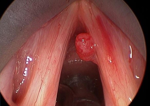 Bệnh polyp dây thanh quản bệnh lành tính, không gây nguy hiểm