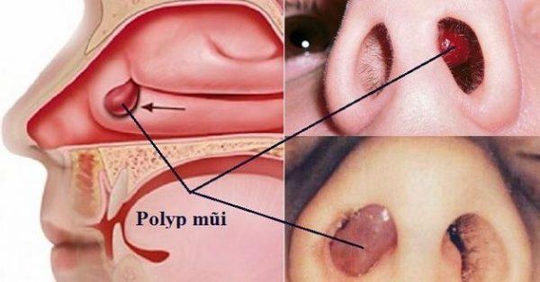 Bệnh polyp mũi là gì? Và phương pháp điều trị