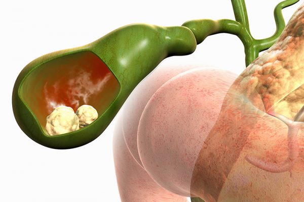 Bệnh polyp túi mật có nguy hiểm không và khi nào cần điều trị?