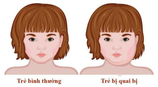 Bệnh quai bị uống thuốc gì?