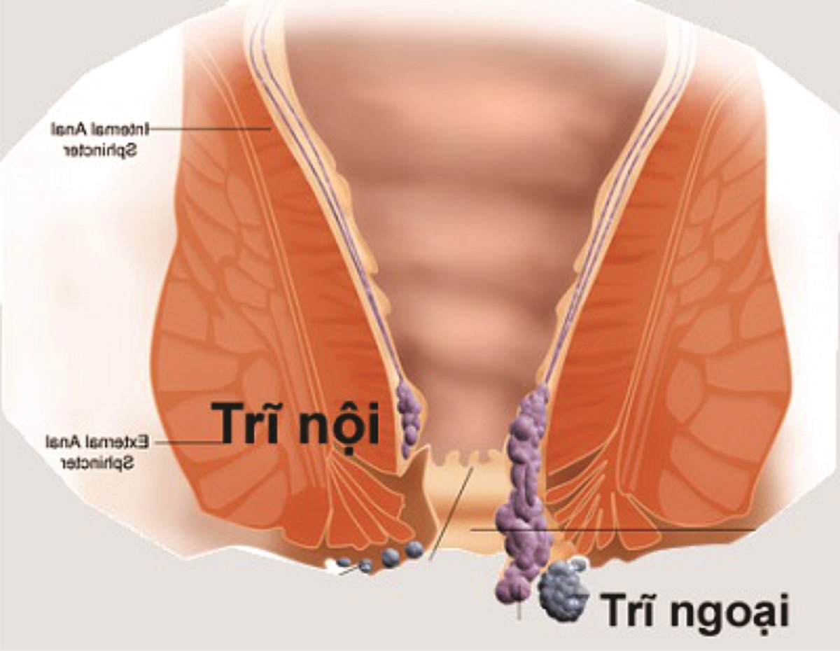 Bệnh rò ở hậu môn nghiêm trọng như thế nào?