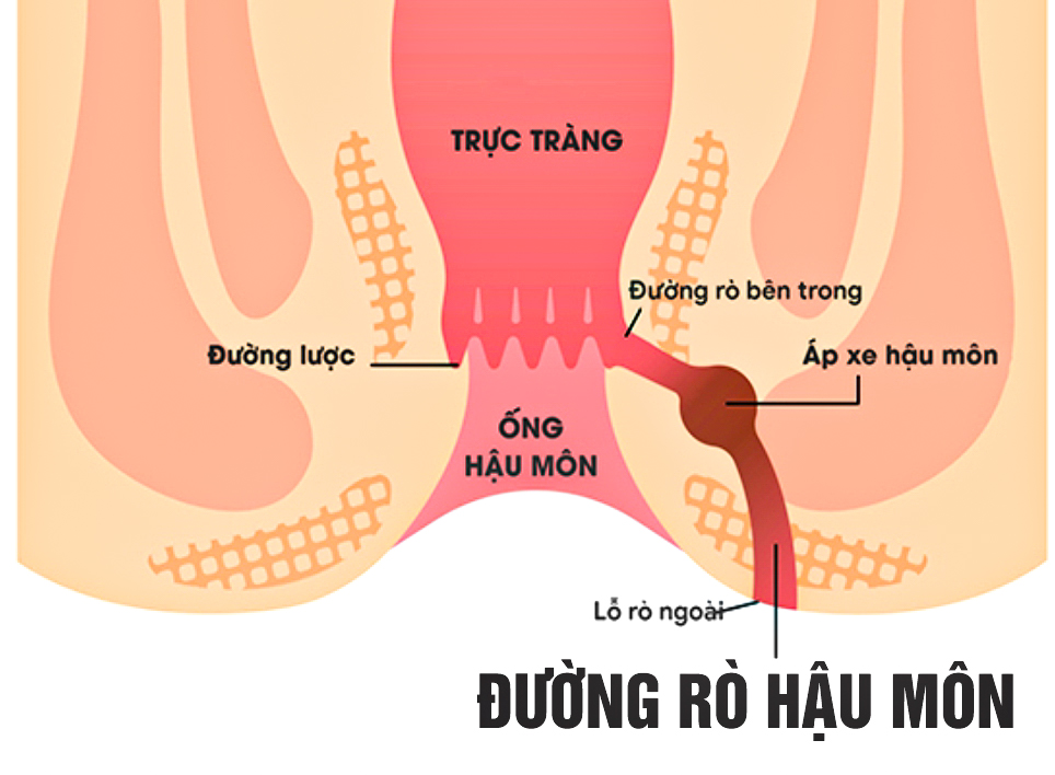 Bệnh rò ở hậu môn và những điều cần biết