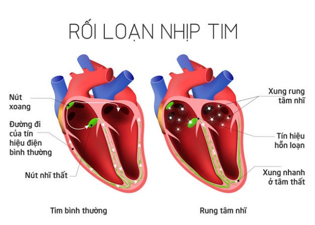 Bệnh rối loạn nhịp tim có chữa được không?