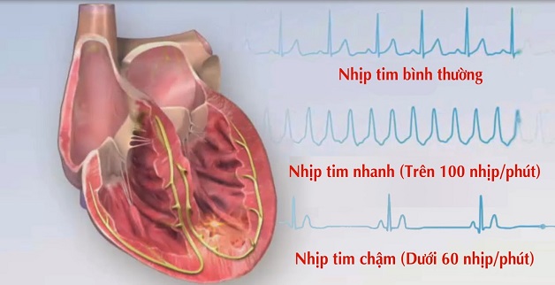 Bệnh rối loạn nhịp tim có nguy hiểm không?