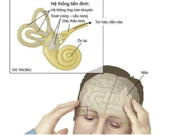 Bệnh rối loạn tiền đình điều trị như thế nào?