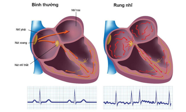 Bệnh rung nhĩ tăng nguy cơ đột quỵ cao gấp 5 lần