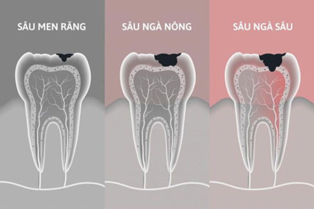 Bệnh sâu răng – Phòng ngừa và điều trị